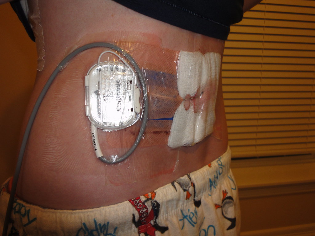 Temporary trial for the spinal cord neurostimulator a photo on Flickriver