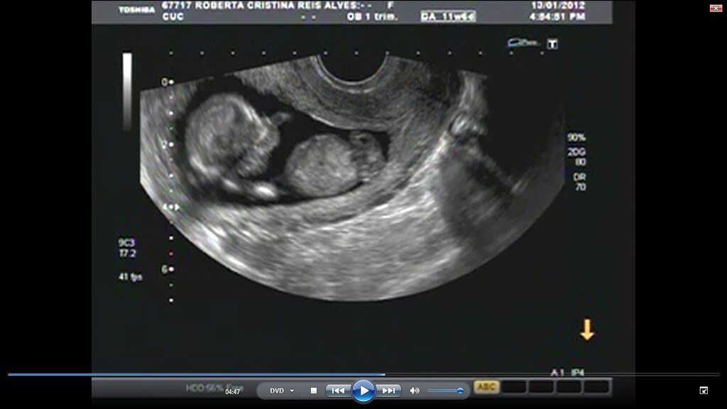 Neném 3 meses Meu nenenzinho com 12 semanas de gestação (3… Flickr