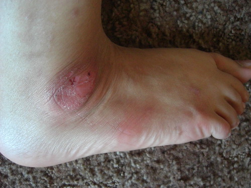 my ugly foot (psoriasis) this type of rash is all over my … Flickr