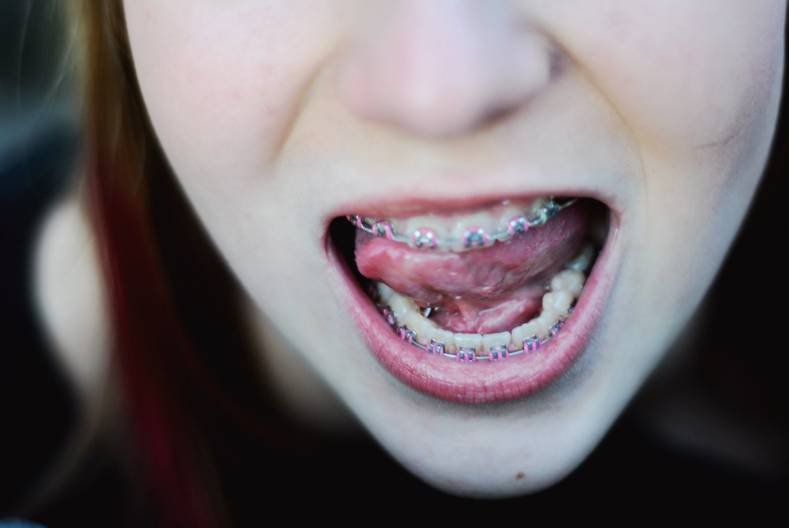 braces are adorable Flickr