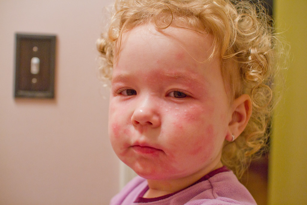 Pistachio Allergy Kara Flickr