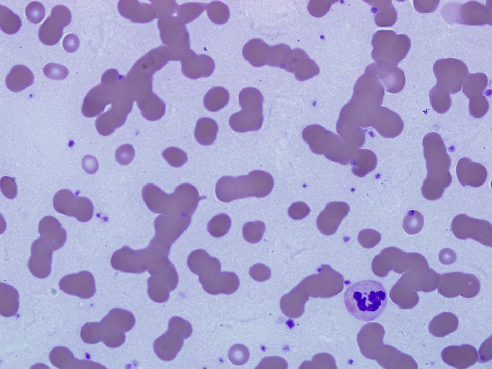 Qiao's Pathology Rouleaux Formation of Red Blood Cells a photo on