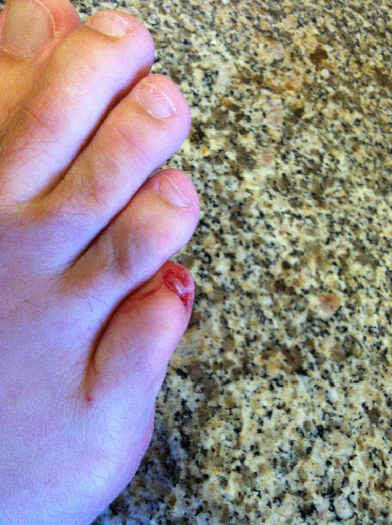 ECNewlin toenail porn. My swimming accident today. I don'… Flickr