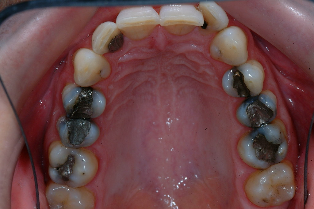 All back teeth white fillings before One of the cosmetic d… Flickr