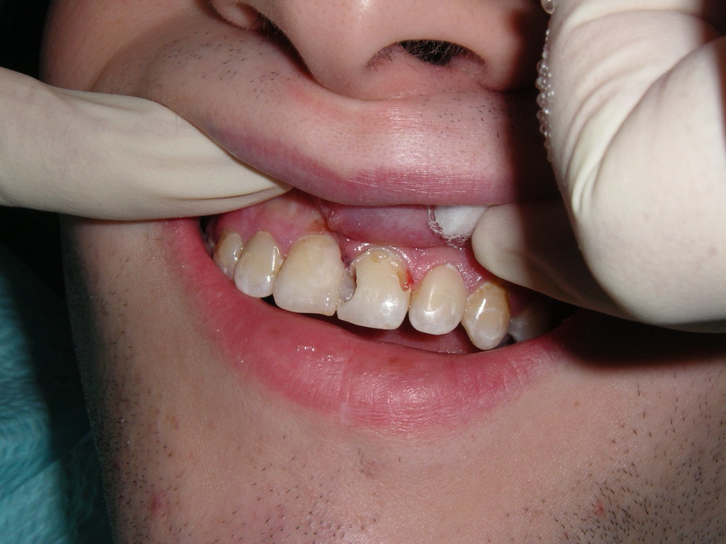 cavity teeth face gross hole Brian Flickr