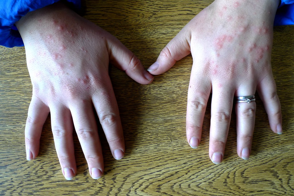 Heat Rash On Hands