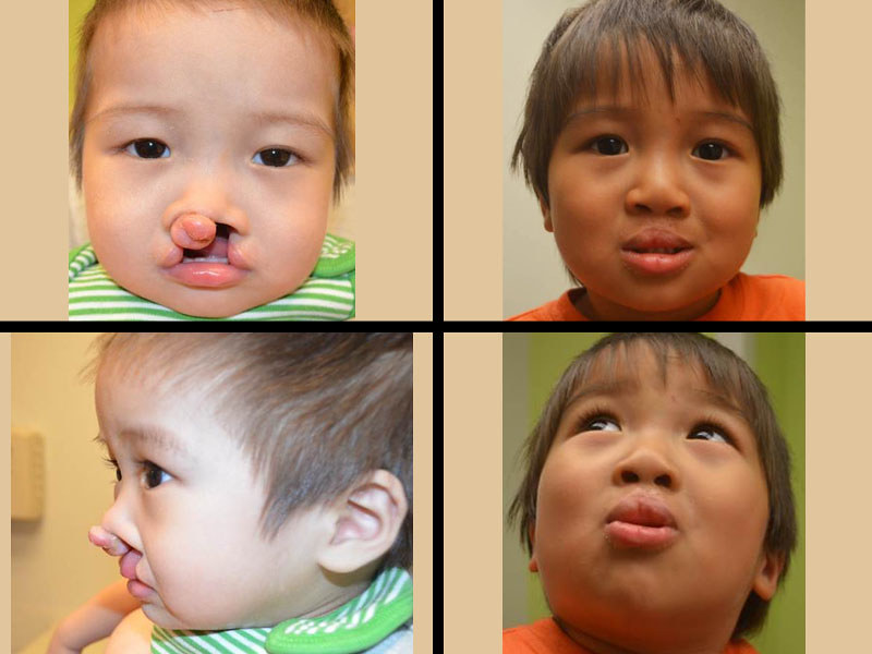 Bilateral Cleft Lip And Palate Repair Insight from Leticia
