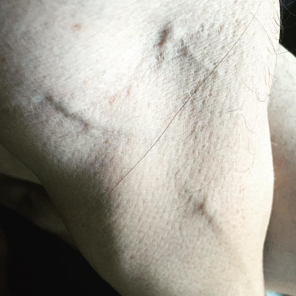 These veins in my left arm sometimes stand out because in