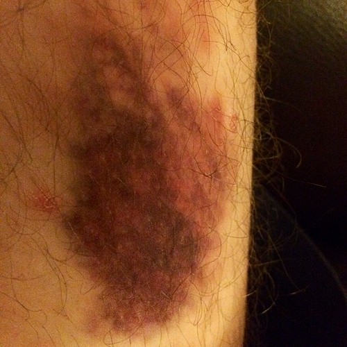 I have no idea how I got this nasty bruise on my leg! Flickr