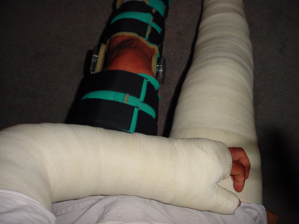Long Leg Cast (LLC) / Long Arm Thumb Spica Cast (LATS) / Long Leg Knee
