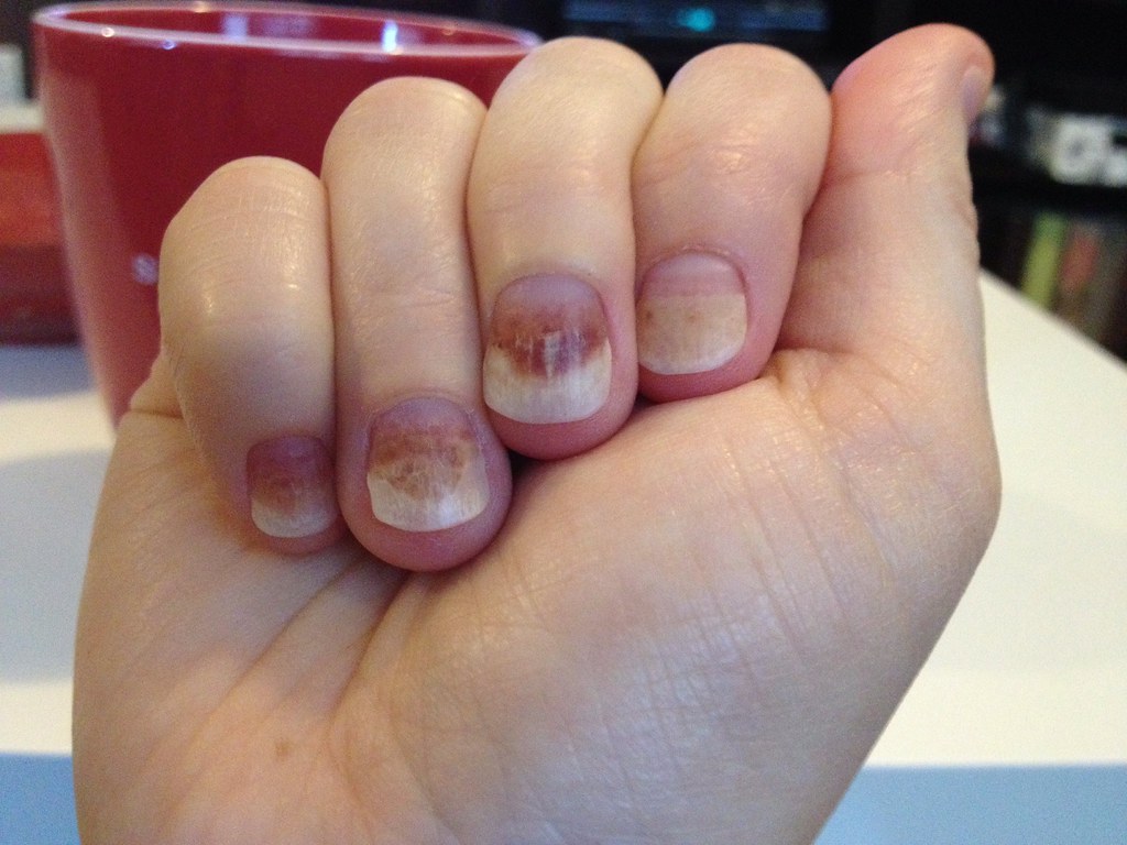 progession of nails darker and more tender alisawindsor Flickr