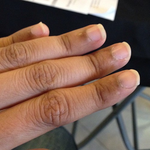 Nail bed all turned black. Chemo side effect. Claire Flickr