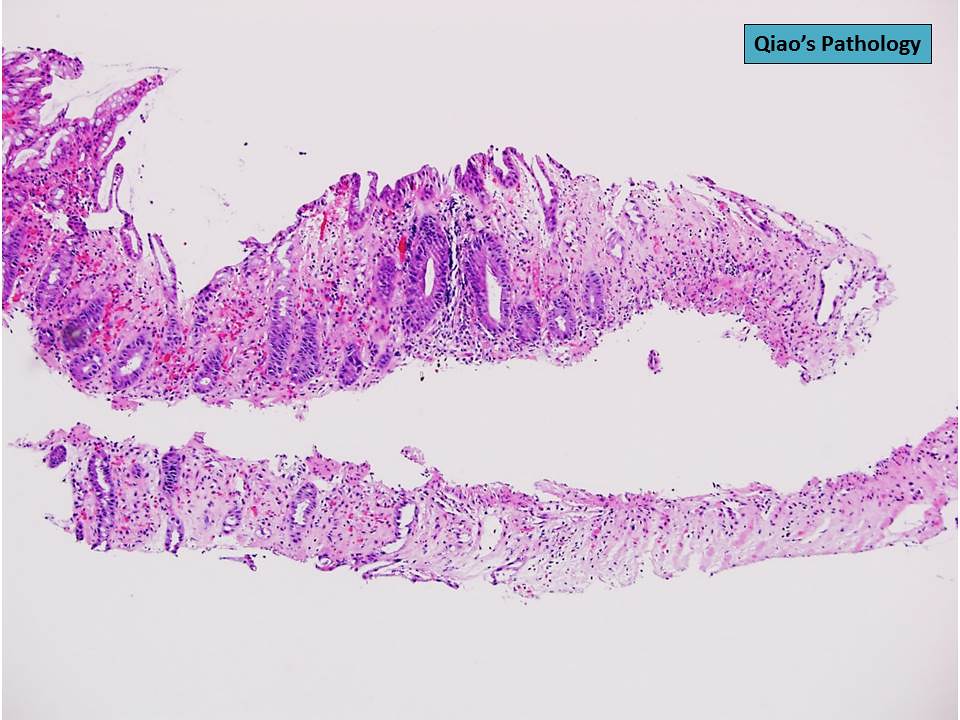 Qiao's Pathology Ischemic Colitis a photo on Flickriver
