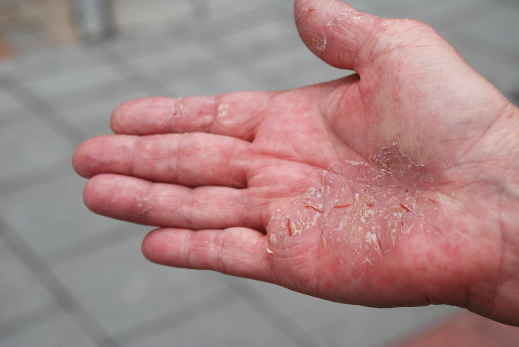 Psoriasis 6 Psoriasis på handflata med svårläkta smärtsamm… Flickr