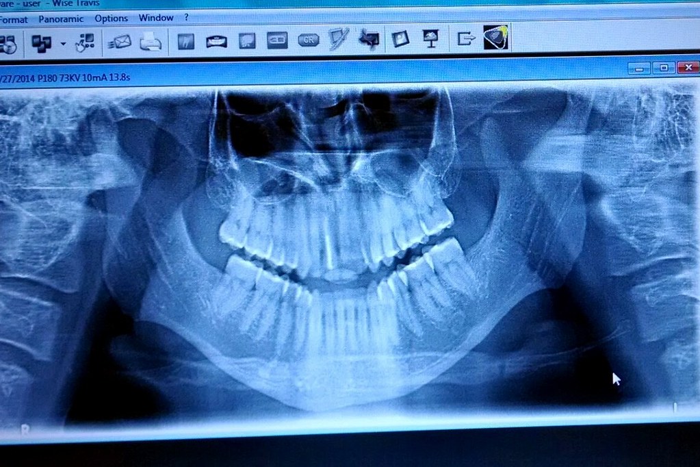 XRay Dental XRay of My Head, Milpitas, California (XRay… Flickr