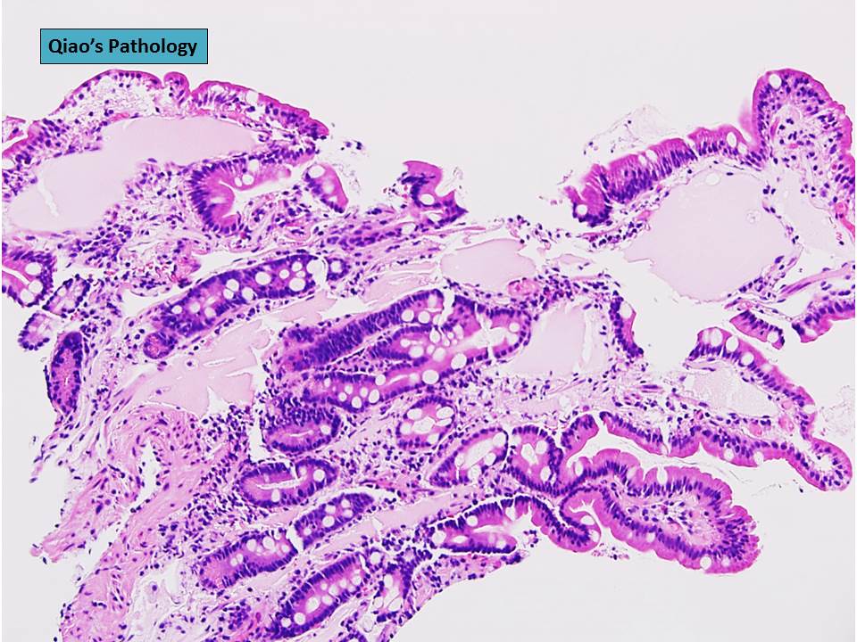 Flickriver Photoset 'Primary intestinal lymphangiectasia (Waldmann's