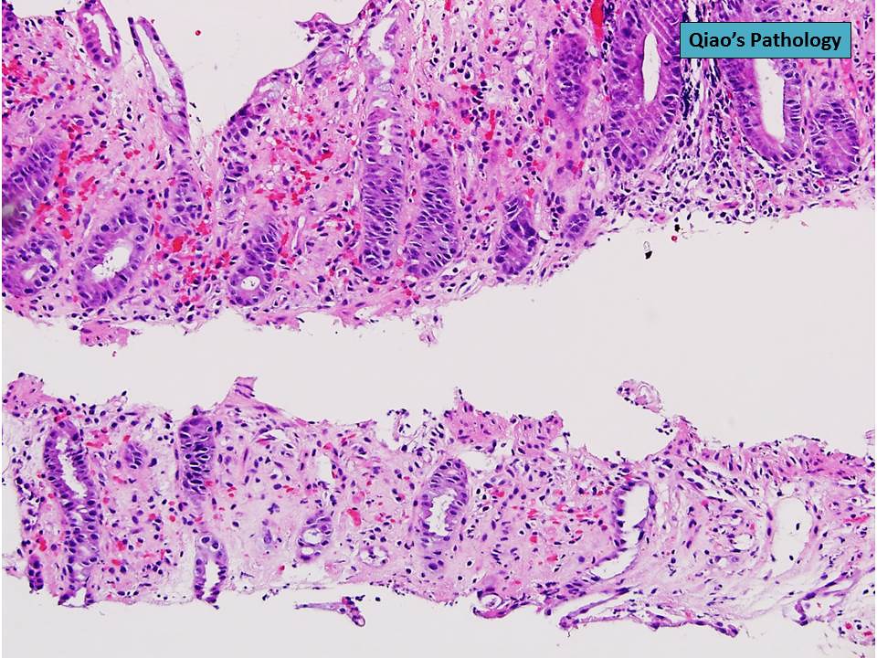 Qiao's Pathology Ischemic Colitis a photo on Flickriver