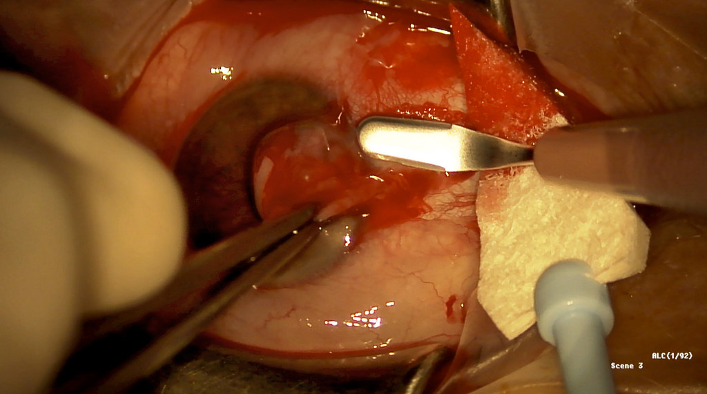 Pterygium surgery Dissecting pterygium off the limbus © An… Flickr