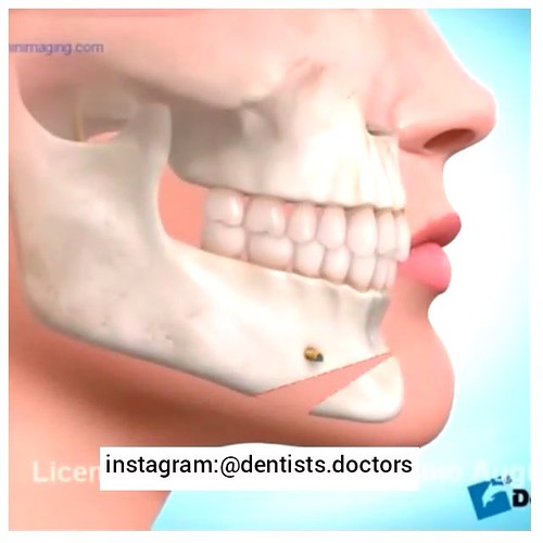 Mentoplasty, advance of chin! Mentoplastía, avance de ment… Flickr