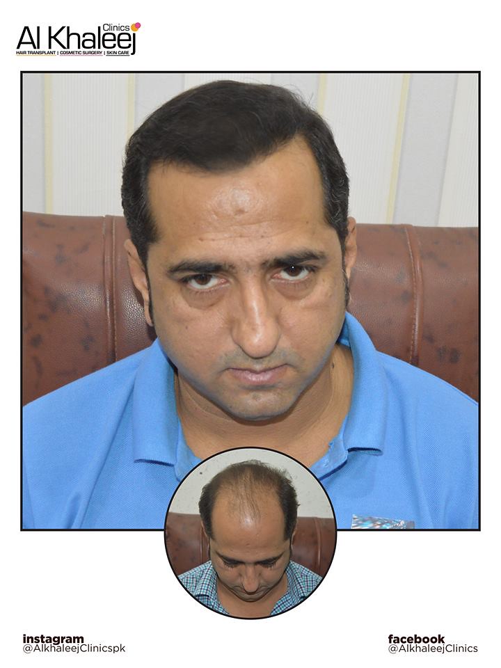 Best Hair Transplant in Karachi Client after getting hair … Flickr