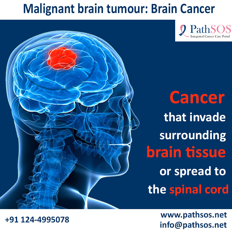 Malignant brain tumour (brain cancer) Malignant brain tumo… Flickr