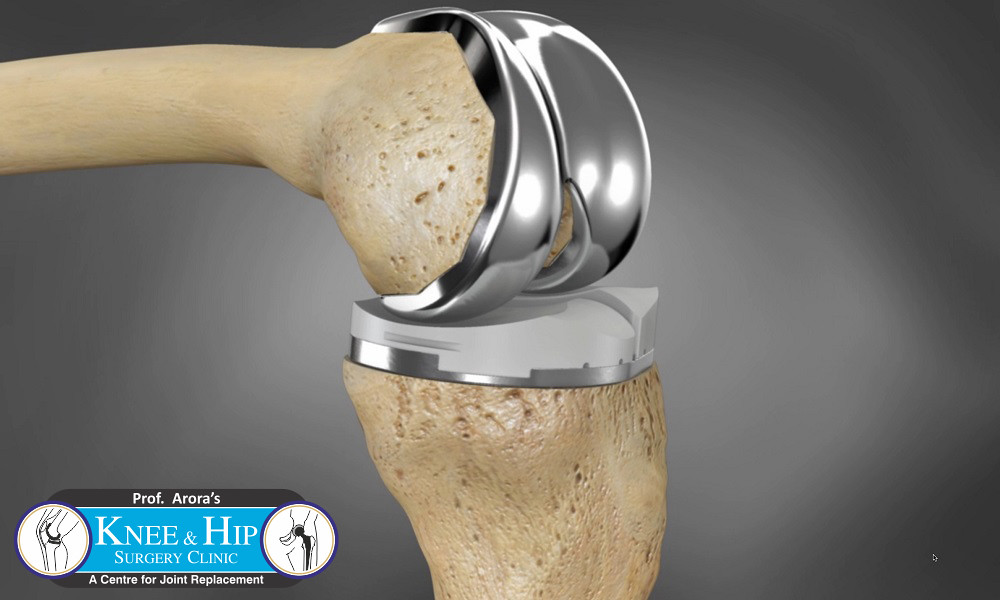Best Knee Replacement Surgeon Delhi Looking for the best k… Flickr