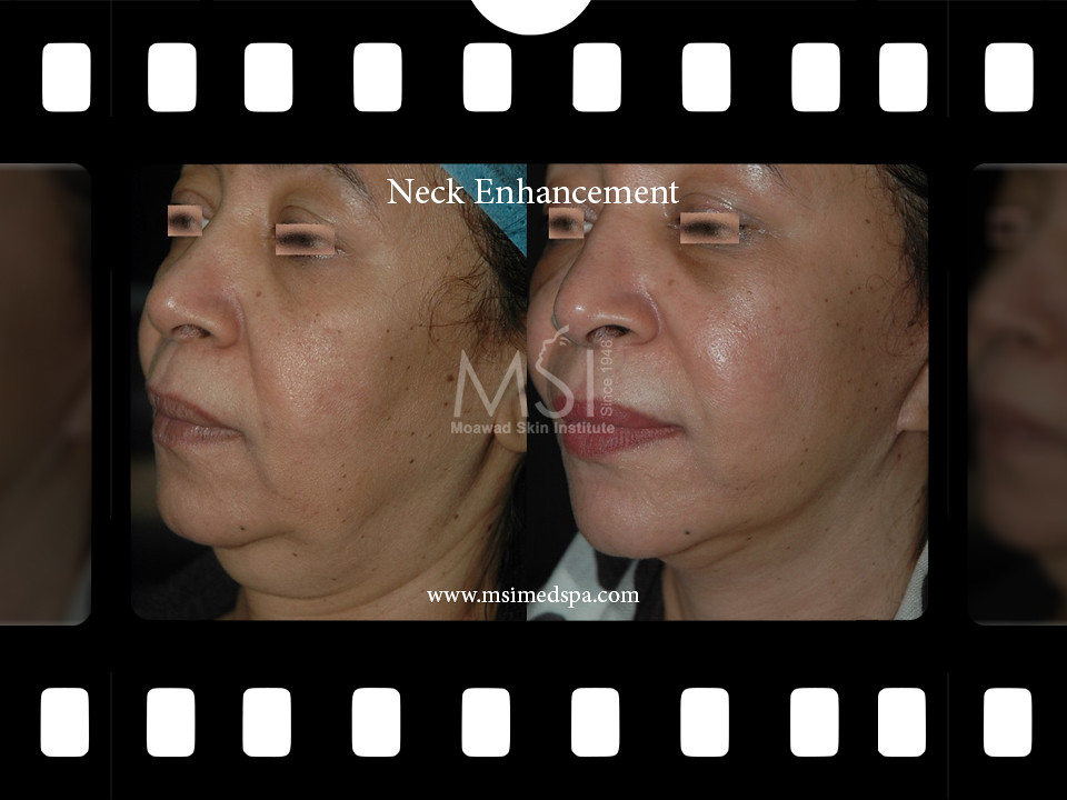 Surgical Face Lift Flickr