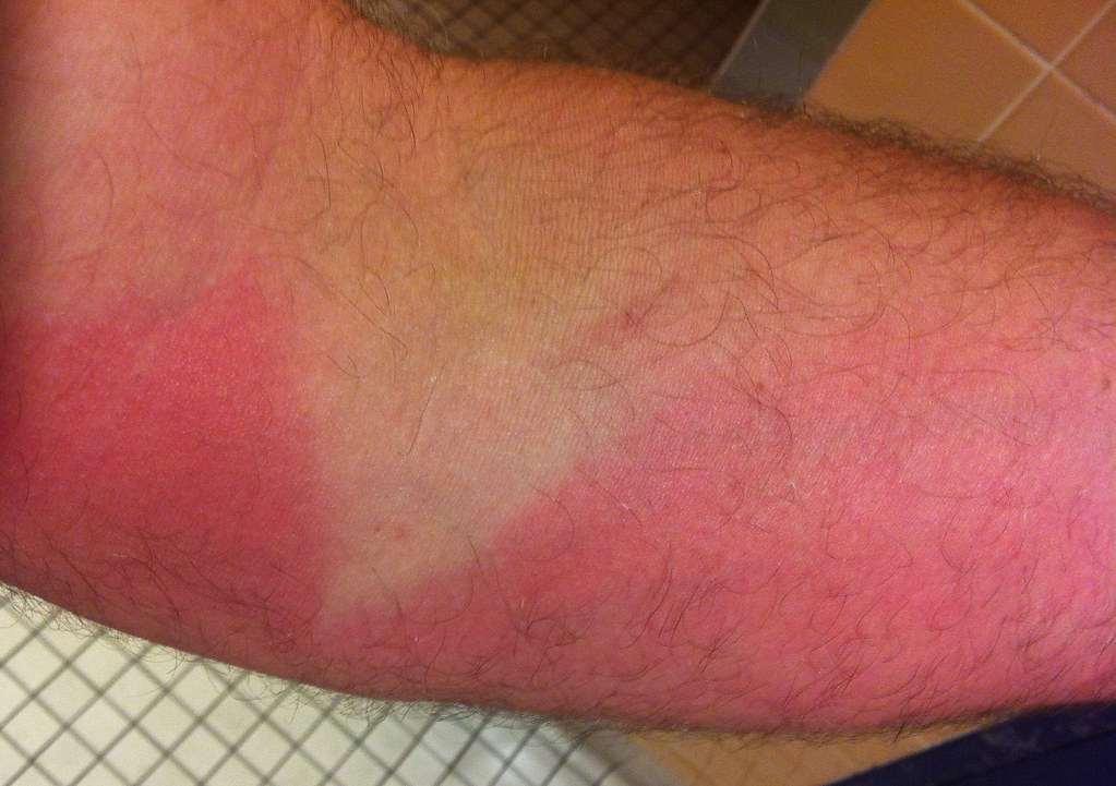 Welder burn maybe thats why the pros wear long sleeves tom labonty