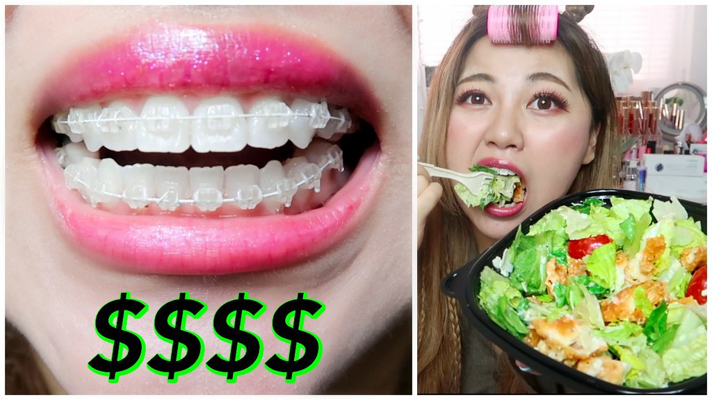 HOW MUCH DOES CLEAR CERAMIC BRACES COST ITSFEIIIDAY Flickr