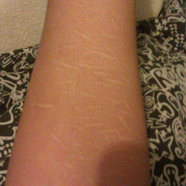 Healed Self Harm Scars 15 Design Ideas by style