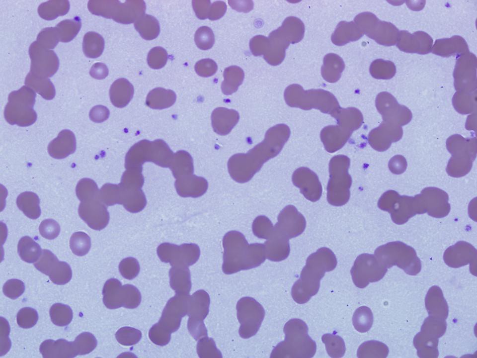 Qiao's Pathology Rouleaux Formation of Red Blood Cells a photo on
