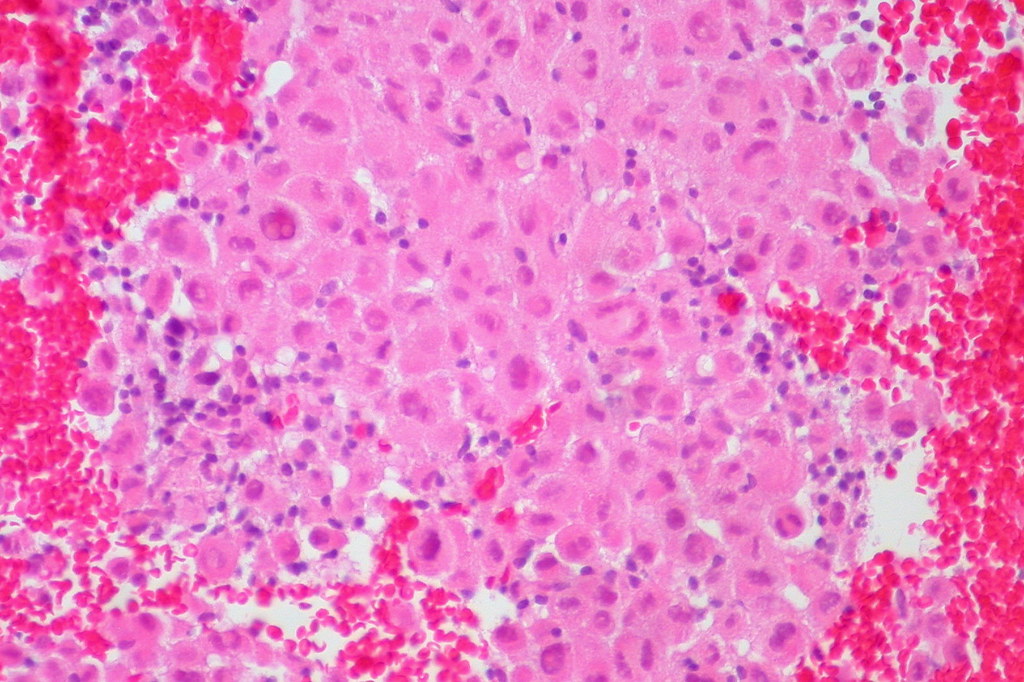 Malignant Melanoma, Liver FNA, Clot Section, H&E Ed Uthman Flickr