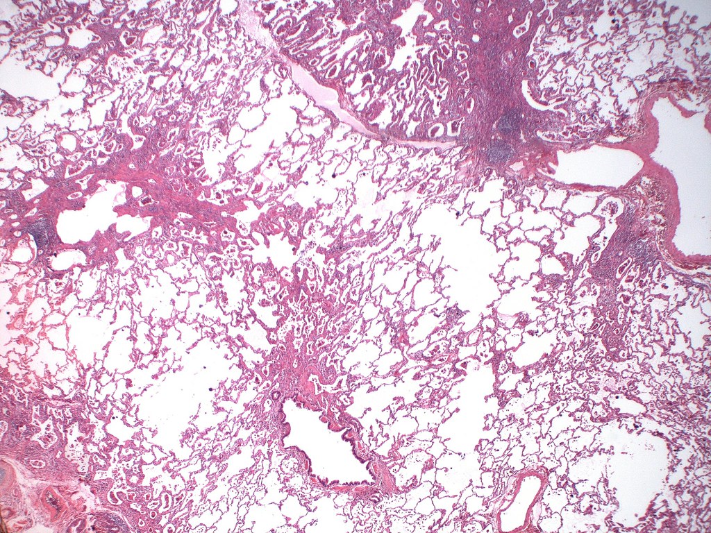 Hard metal lung disease/Giant cell interstitial pneumonia (GIP) Case