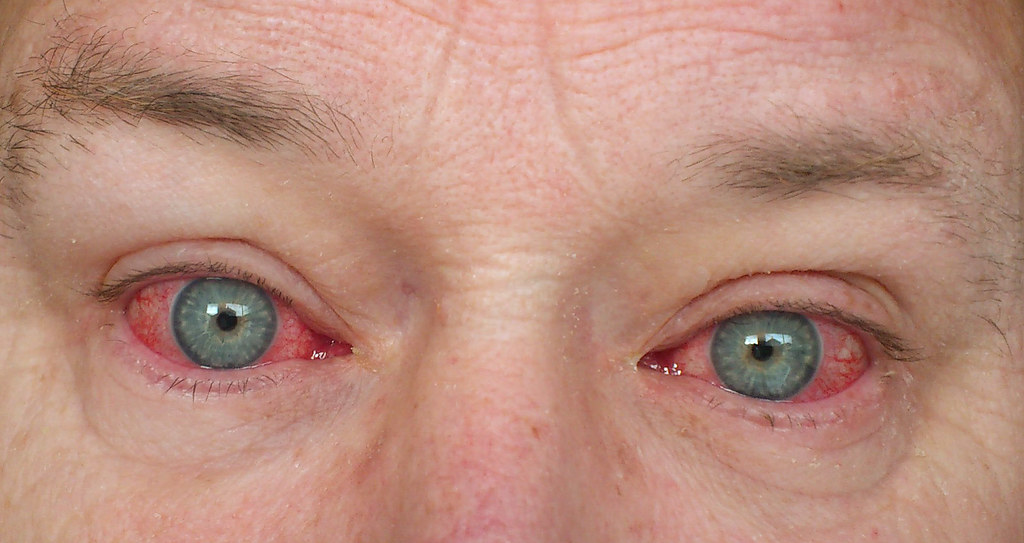 Red Eyes Hurt I can't spend much time on computer screens … Flickr