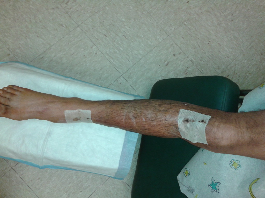 Broken Leg with Rod Flickr