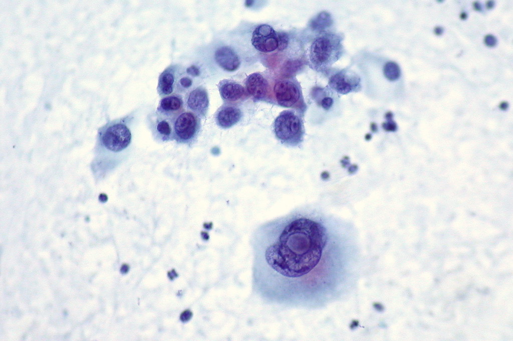 Malignant Melanoma, Liver FNA, Direct Smear, Pap Stain a photo on