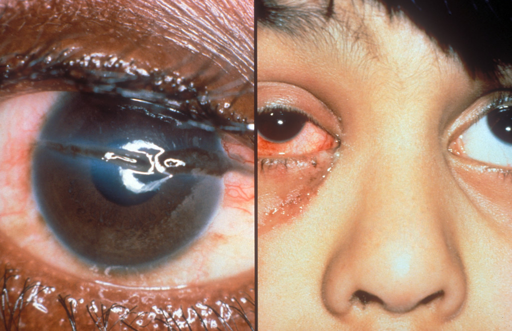 corneal injury, secondary to trauma Corneal … Flickr