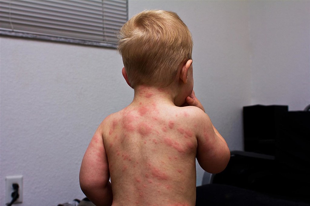 Exanthema subitum (roseola infantum, sixth disease, threeday fever