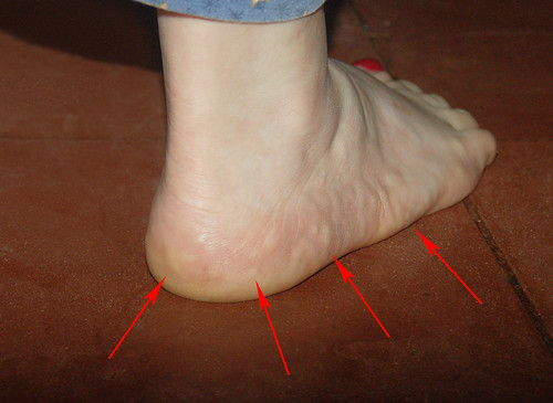 Piezogenic Pedal Papules Those little bumps are small hern… Flickr
