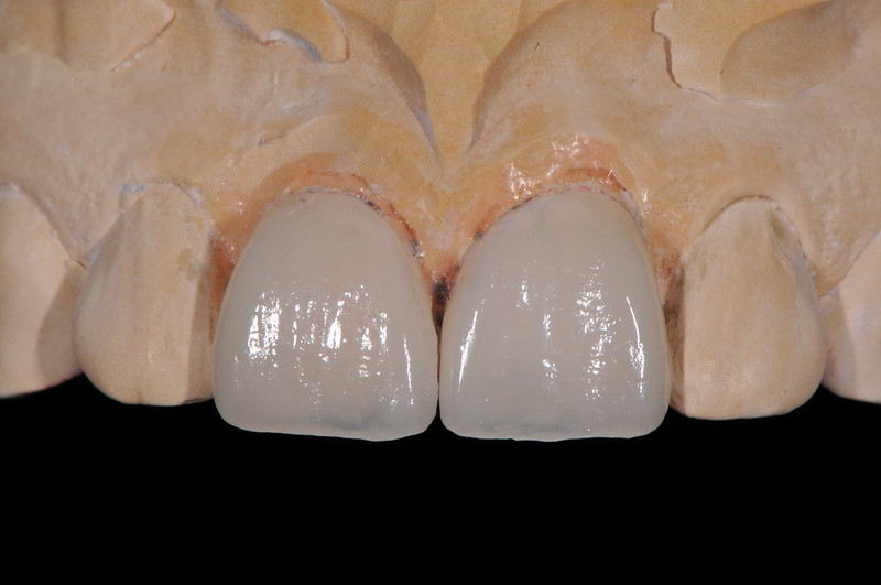 Veneers Studio32 Dental Laboratory