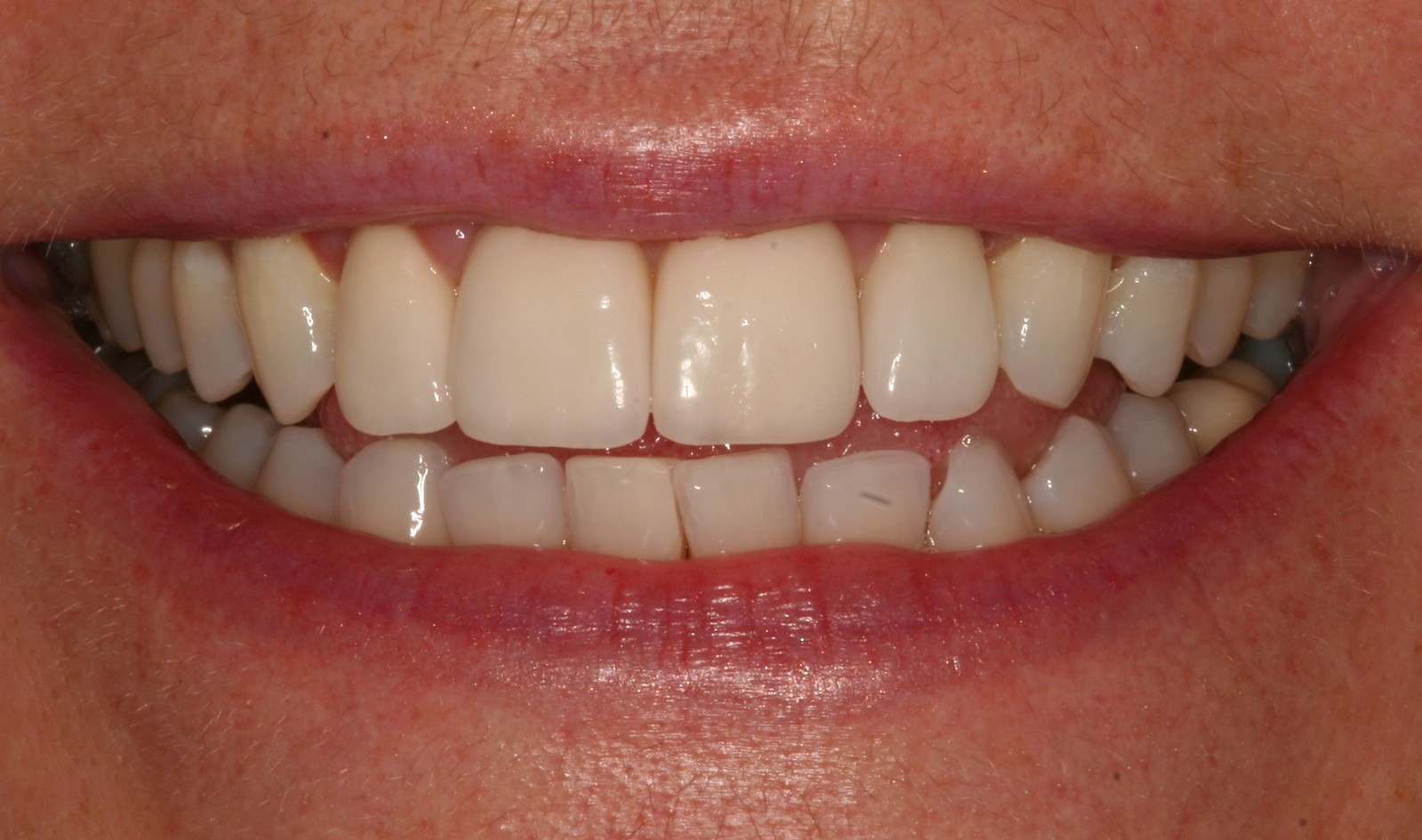 Porcelain veneers for yellowing teeth Flickr