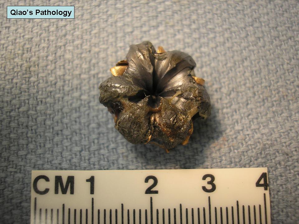 Qiao's Pathology An expanded jacketed hollowpoint bullet removed from
