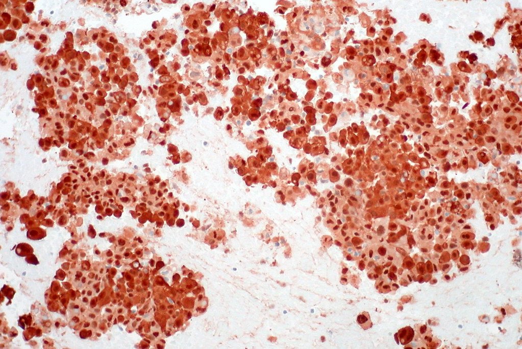 Malignant Melanoma, Liver FNA, Clot Section, S100 Protein a photo on