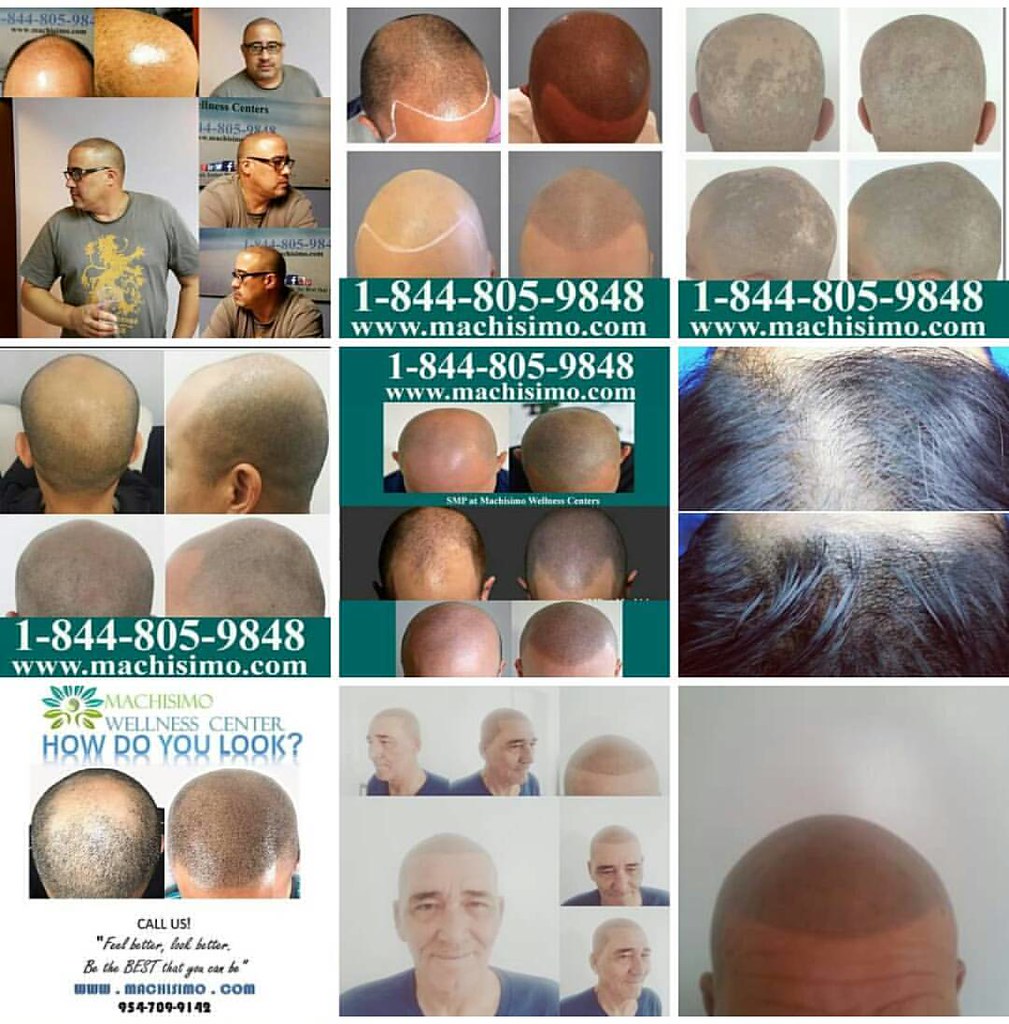 Advanced Hair follicle replication procedure a.k.a Scalp m… Flickr