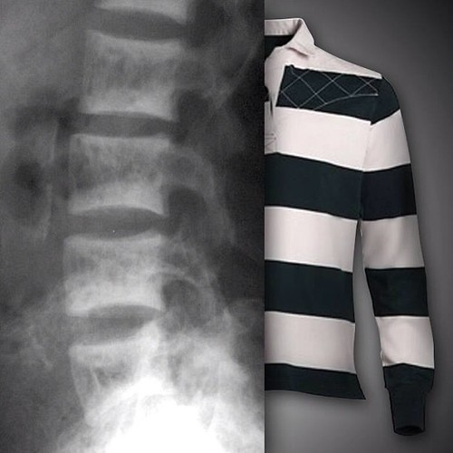 Rugger jersey spine prominent vertebral subendplate dens… Flickr