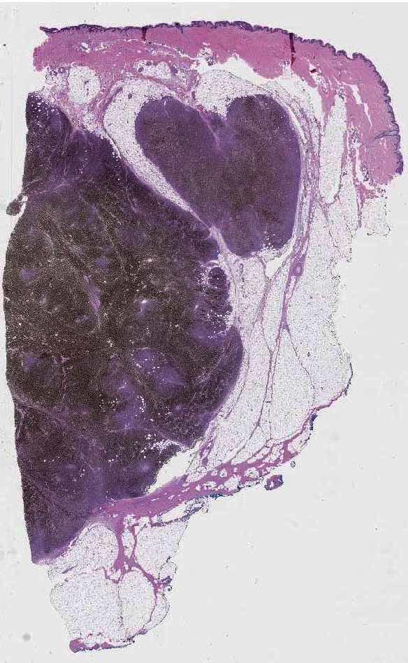 1 Vulva Melanoma. Melanoma recurrence in subcutaneous fi… Flickr
