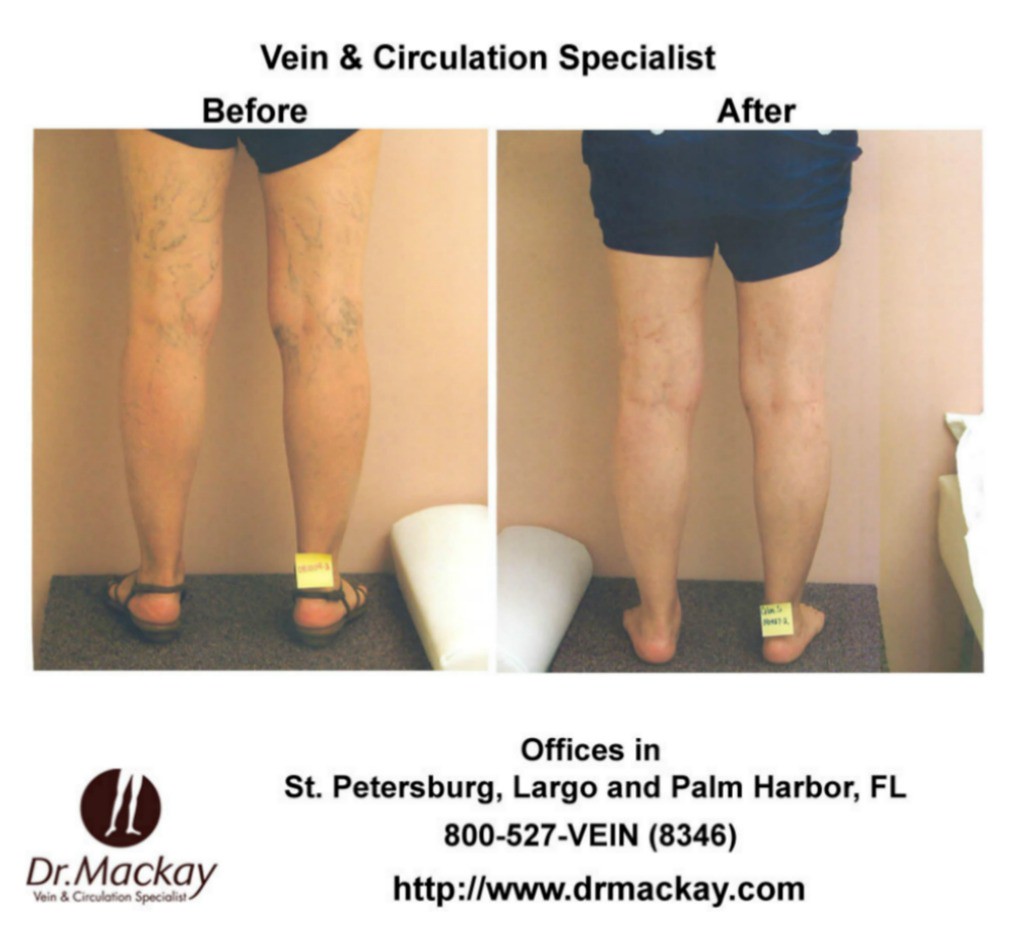 Vein Center Largo FL Images from Dr. Edward G. Mackay Vein… Flickr
