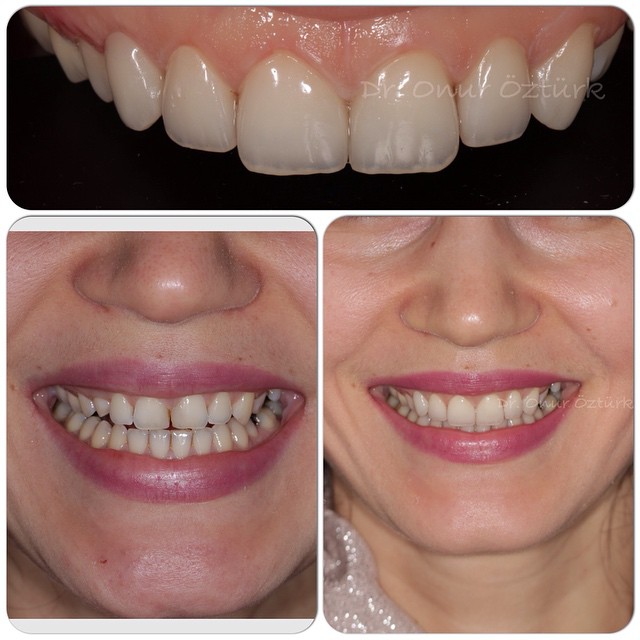 Üst ön 6 dişe e.max porselen laminate veneer laminate la… Flickr