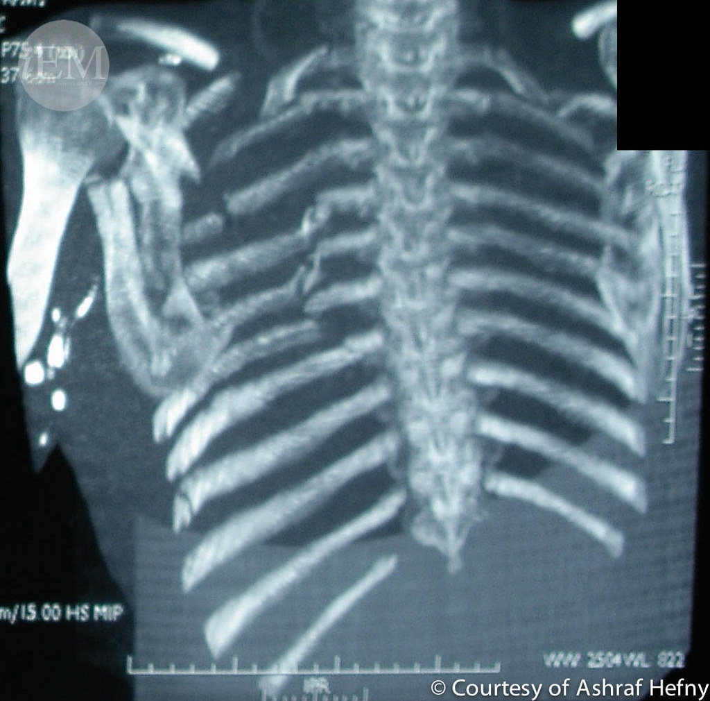 8 Flail Chest 5 Ribs Emergency Medicine Clinical Images and