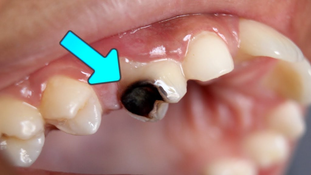 How are Dental Caries Formed? What Causes Dental Caries an